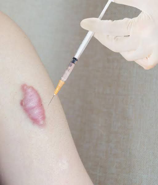 Before After Keloid Treatment